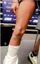  ??  ?? Superstar Rossi präsentier­te sein lädiertes Knie