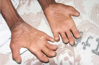  ??  ?? Fingers of a leprosy patient Source healthmap