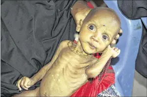  ?? FARAH ABDI WARSAMEH / AP ?? A mother who fled the drought in southern Somalia holds her malnourish­ed 9-month-old at a feeding center in a camp in Mogadishu last month. Aid agencies in the capital have been overwhelme­d by displaced people seeking food.