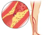  ?? (Courtesy) ?? FATTY SUBSTANCES build up in the walls of an artery, causing poor blood flow to the leg.