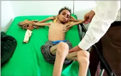 ??  ?? File photo shows a doctor checking malnourish­ed Ghazi Ahmad, 10, at a hospital in Taiz, Yemen. — Reuters photo