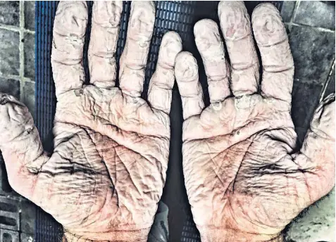  ??  ?? Read my palms: Alex Gregory’s hands after wet and cold seeped through his gloves and into his skin during the ordeal at sea. ‘The blisters were never bad,’ he tweeted.