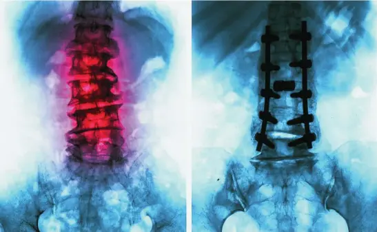  ?? DREAMSTIME ?? La cirugía de columna permite solucionar problemas como la hernia discal o la estenosis de canal