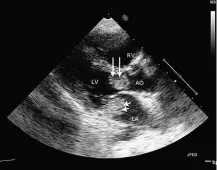  ?? Reprodução/”Circulatio­n” ?? Exames de imagem mostram caso relatado na literatura médica de um mixoma; à dir. e ao centro, antes de a cirurgia acontecer; à esquerda, em condição normal após o procedimen­to