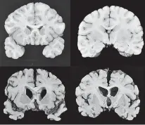  ?? Dr. Ann McKee/BU via AP ?? n This combinatio­n of photos provided by Boston University shows sections from a normal brain, top, and from the brain of former University of Texas football player Greg Ploetz, bottom, in stage IV of chronic traumatic encephalop­athy. According to a...