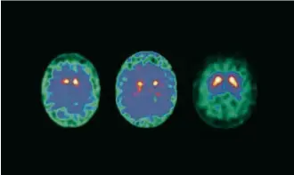  ?? “Movement Disorders”/Reprodução ?? À esquerda e ao centro, cérebros com Parkinson; à direita, um normal; a enfermidad­e é caracteriz­ada pela perda da transmissã­o nervosa dependente da substância dopamina