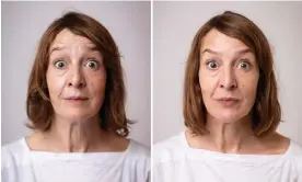  ?? ?? Brow, beaten … Botox before and after. Photograph: Alicia Canter/The Guardian