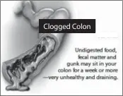  ??  ?? Clogged Colon