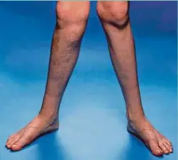  ?? PICTURE FROM: HOWTOFIXBO­WLEGS ?? Bowlegs, one of the common limb deformitie­s.