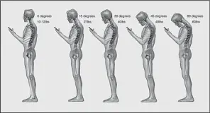  ?? The Washington Post/DR. KENNETH HANSRAJ ?? Smartphone users’ excessive pressure on their necks “is an epidemic or, at least, it’s very common,” says spine surgeon Kenneth Hansraj.