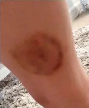  ??  ?? Painful: The bruising on the child’s thigh