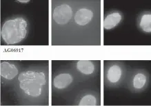  ??  ?? This combinatio­n of images shows progeria-damaged human cells without Lonafarnib treatment, left column; cells with a more normal shape after a low dose, centre; cells after a higher dose, right.