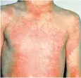  ??  ?? A scarlet fever rash on a boy’s body