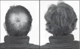  ??  ?? Breakthrou­gh research proves this discovery helps fill-in bald spots, re-nournishes thinning hair, and leads to noticeable growth in as little as 30 days.