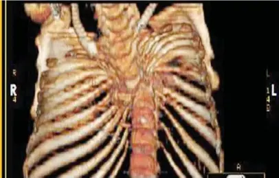  ??  ?? Scan shows spinal deformity that’s paralysed Ummi