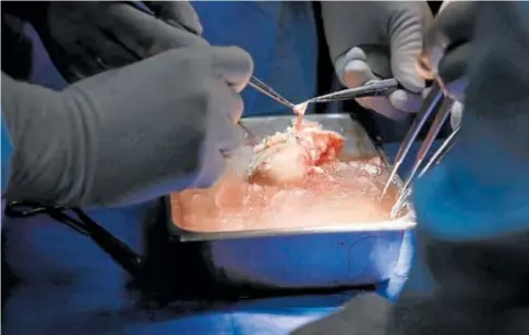  ?? // AFP ?? Este es el riñón porcino implantado en un varón de 62 años que fue modificado genéticame­nte