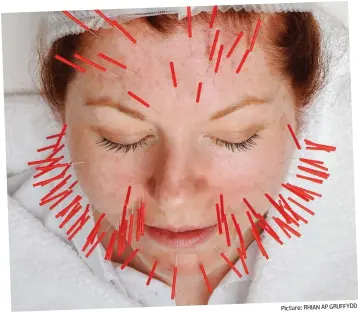  ??  ?? Rejuvenati­ng: Marianne having facial acupunctur­e Picture: RHIAN AP GRUFFYDD