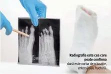  ??  ?? Radiografi­a este cea care poate confirma dacă este vorba de o luxaţie, entorsă sau fractură.