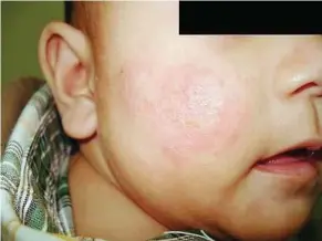  ??  ?? Some children have a mild form of atopic dermatitis which is characteri­sed by dry, itchy patches and minimal redness.