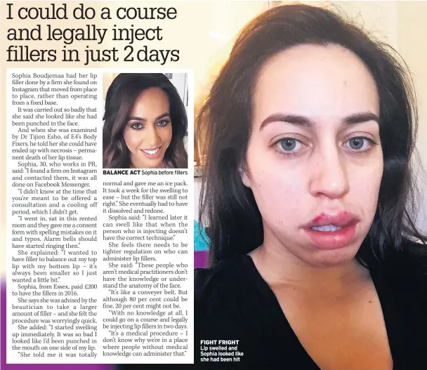  ??  ?? BALANCE ACT Sophia before fillers FIGHT FRIGHT Lip swelled and Sophia looked like she had been hit