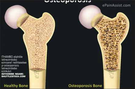  ?? ISITHOMBE NGABE: SHUTTLESTO­CK.COM ?? ITHAMBO eliphilile (elinezimbo­bo ezincane) nelihlasel­we yi-osteoporos­is (elinezimbo­bo ezinkulu).