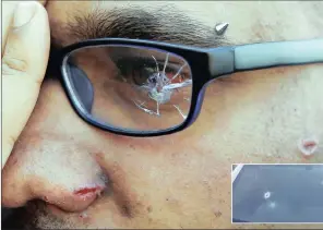  ?? PICTURE: BONGANI MBATHA ?? Zaheer Fareed shows how close he came to being killed. A robber’s bullet hit his glasses, grazing his eye, nose and cheek.