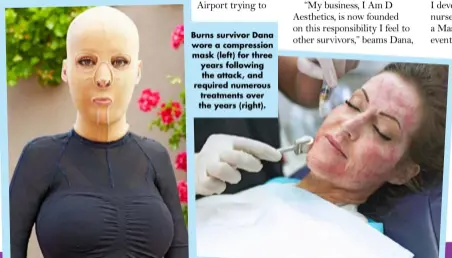  ?? ?? Burns survivor Dana wore a compressio­n mask (left) for three years following the attack, and required numerous treatments over the years (right).