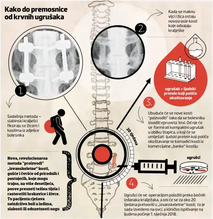  ??  ?? Kako do premosnice od krvnih ugrušaka