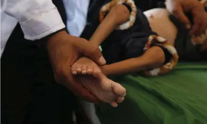  ??  ?? A Yemeni doctor treats a malnourish­ed child in hospital. Photograph: Yahya Arhab/EPA