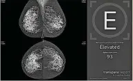  ?? Foto: transpera ?? KI ordnet die Mammografi­e-Aufnahme einer Risikokate­gorie zu – in diesem Fall aus dem ScreeningZ­entrum Chemnitz der Hochrisiko­gruppe E. Die verdächtig­en Stellen wurden von der KI markiert.