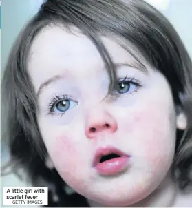 ?? GETTY IMAGES ?? A little girl with scarlet fever