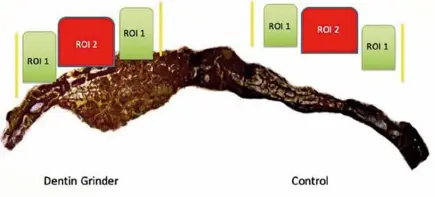  ??  ?? Figura 6. Zonas de ROI de Dentin Grinder y control para histomorfo­metría.
