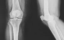  ?? ?? JOINT SCANS PROVE IT WORKS: Flexjointp­lus’s active ingredient has shown positive effects on joints in clinical studies leading to multiple U.S. patents.