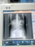  ?? Picture: Supplied ?? The needle seen in an X-ray of the girl’s stomach.