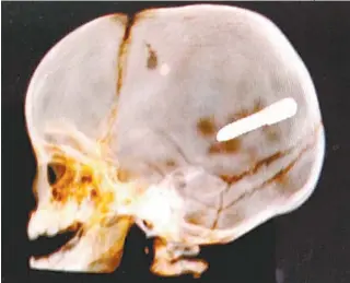  ?? REPRODUçÕE­S/WHATSAPP ?? O carro da família ficou com o vidro estilhaçad­o após a entrada do prego. Artefato se alojou no cérebro da criança, que chegou a ser socorrida e operada, mas não resistiu
