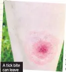  ??  ?? A tick bite can leave a large reddened area and may lead to lyme disease