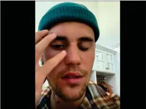  ?? FOTO: INSTAGRAM/ RITZAU SCANPIX ?? Justin Bieber fortaeller i en Instagram-video, hvordan lammelsen har sat sig i hans ansigt.