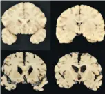  ?? DR. ANN McKEE/THE ASSOCIATED PRESS ?? A recent study by Scottish neuropatho­logist Dr. William Stewart found “no significan­t associatio­ns between number of concussion­s and performanc­e on cognitive tests.”