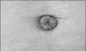 Bloedende Navel Oorzaken Van Beetje Bloed Uit Navel Pressreader