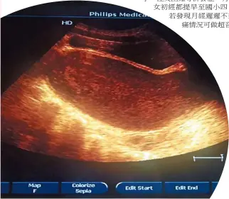  ??  ?? (張裕珍)少女腹痛許久，經超音波檢查發現子宮­與陰道滿是積血，確診為處女膜閉鎖。(記者張裕珍／翻攝)