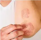  ?? ?? La Psoriasis es una afección en la que las células de la piel se acumulan para formar escamas y manchas secas