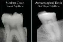  ?? MCMASTER UNIVERSITY ?? Researcher­s found that the shape of black area inside the tooth, known as the "pulp horns," that’s visible on an X-ray gives an indication of vitamin D deficiency.