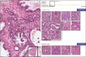  ??  ?? Het SMILY-systeem zoekt bij een weefselsca­n (links) vergelijkb­are opnamen, gesorteerd volgens de Gleason-score die het risico bij tumoren categorise­ert.