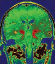  ??  ?? Parkinsons sjukdom får delar av hjärnan att degenerera.