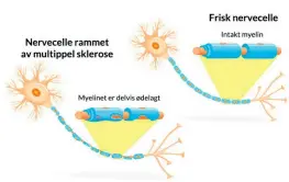  ?? ?? MS ANGRIPER MYELINET. Fettstoffe­t myelin ligger rundt nervefibre og hjelper vanligvis med å øke hastighete­n av impulser mellom nervefibre slik at beskjeder mellom hjernen og ryggmargen formidles raskt og effektivt. Ved MS blir myelinet angrepet.