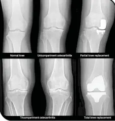  ?? ?? (Top, from left) X-ray images show a normal knee; unicompart­ment OA with some wearing on inner side of knee; and post-partial knee replacemen­t. (Above, from left) Tricompart­ment OA with severe damage to both knees; and post-total knee replacemen­t.