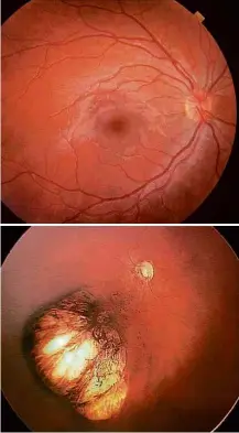  ?? Divulgação ?? Acima, uma retina normal; abaixo, uma afetada pela zika SATÉLITE