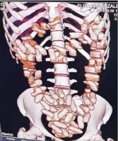  ?? SUPPLIED ?? An X-ray scan of Venezuelan national Yosbeilys Katerine Flores Gonzalez shows more than 100 pellets of cocaine, weighing over 1 kilogram, in her digestive system.