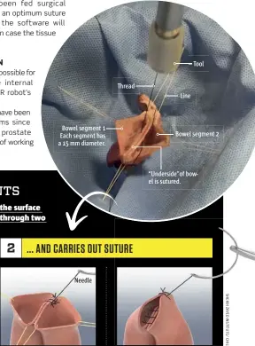  ??  ?? The two bowel segments to be joined are placed vertically beside each other. The robot holds on to the segments in four places to be able to join the two sides and keep the rest outstretch­ed.