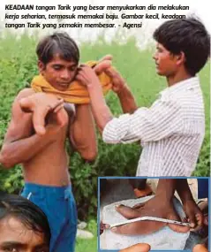  ??  ?? KEADAAN tangan Tarik yang besar menyukarka­n dia melakukan kerja seharian, termasuk memakai baju. Gambar kecil, keadaan tangan Tarik yang semakin membesar. - Agensi